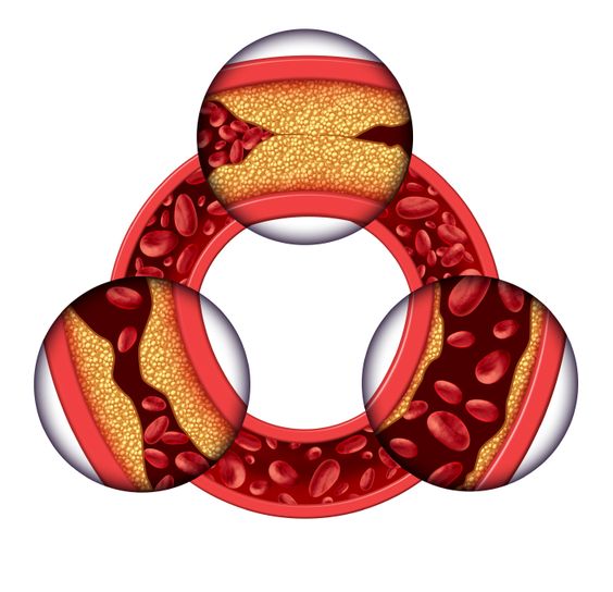 Atherosclerosis: Symptoms and Treatment